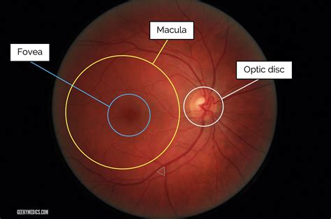 Fundoscopic Appearances of Retinal Pathologies | Geeky Medics