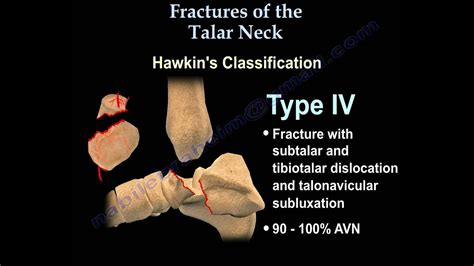 Talus fracture, Hawkin's Classificaiton - Everything You Need To Know ...