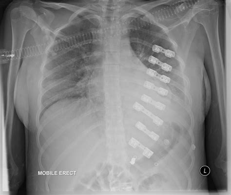 Mucus In Lungs X Ray