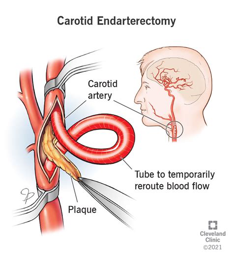 Carotid Endarterectomy: การรักษาโรคหลอดเลือดหัวใจ - MedThai