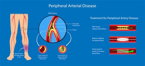 Peripheral Arterial Disease - Symptoms and Causes | Dr Raghu