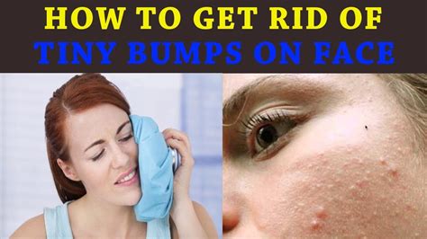 Get Rid Of Bumps In Face - get rid of bumps