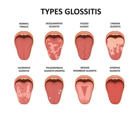 Glossitis: Causes, Symptoms, and Treatment