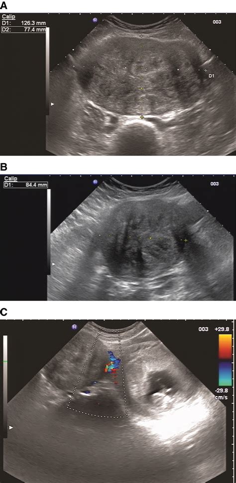 Vaginal delivery after laparotomic myomectomy during pregnancy