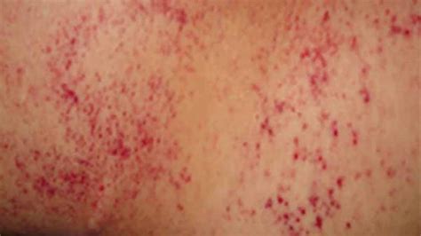 Ecchymosis; Definition, Symptoms, Causes and Treatments