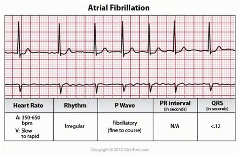 Atrial flutter vs afib - hourhac