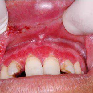 Mucosal leishmaniasis caused by different Leishmania species throughout ...