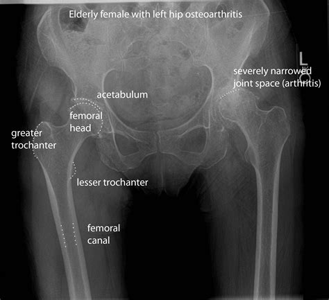 Anterior Inferior Iliac Spine Avulsion Fracture Treatment - mapasgmaes