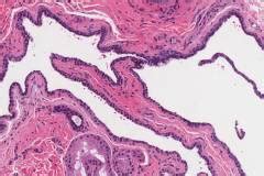 Hidrocystoma | Ottawa Atlas of Pathology