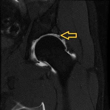 Labral Tears and FAI: A Common Cause of Hip Pain – Howard J. Luks, MD