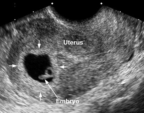 Can A Molar Pregnancy Be Misdiagnosed? - Classified Mom