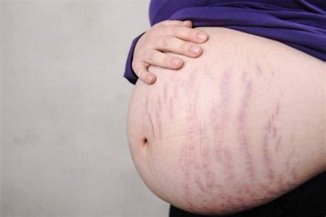 How Can You Reduce Stretch Marks During Pregnancy? – MamasChoice Vietnam