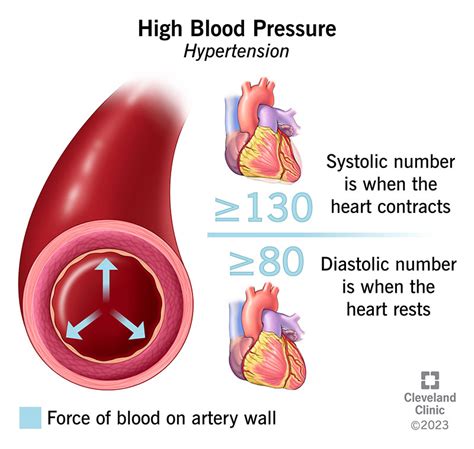 Understanding Hypertension: Causes, Symptoms, And Treatment - Ask The ...