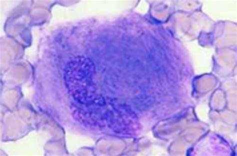 Glucosyl Cerebroside Lipidosis