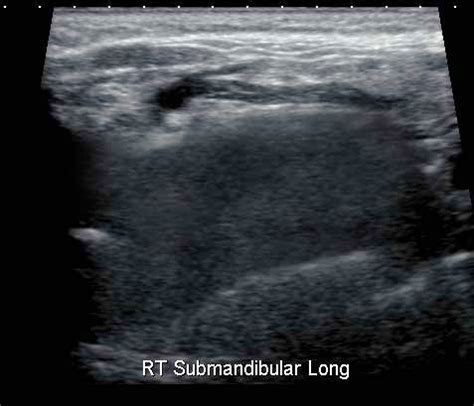 Submandibular Gland Normal - Ultrasoundpaedia