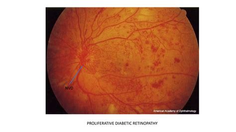 Homeopathic Eye Drops For Diabetic Retinopathy at Timothy Runnels blog