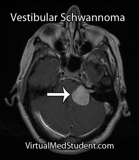 Acoustic Neuroma, and Really We Mean Vestibular Schwannoma ...