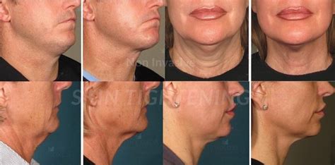 The Best Non Surgical Skin Tightening Treatment For Face and Body - My ...