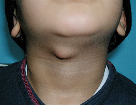 Thyroglossal Duct Cyst - Pictures, Symptoms, Treatment and Surgery