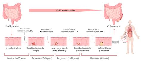 Cancers | Free Full-Text | Colorectal Cancer: A Review of ...