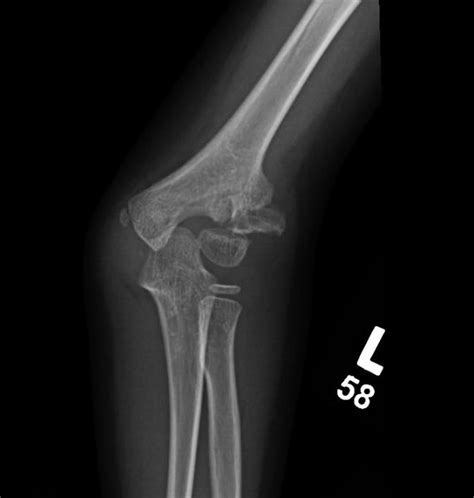 Pediatric Lateral Condyle Fracture