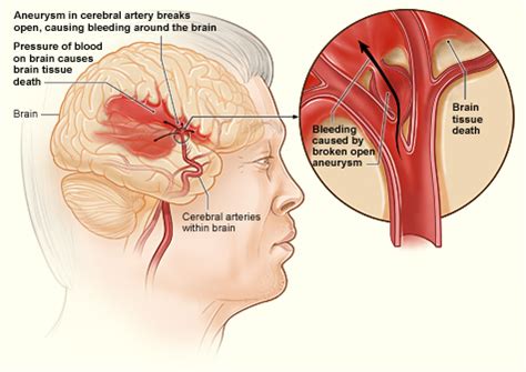 Internal bleeding - Wikipedia