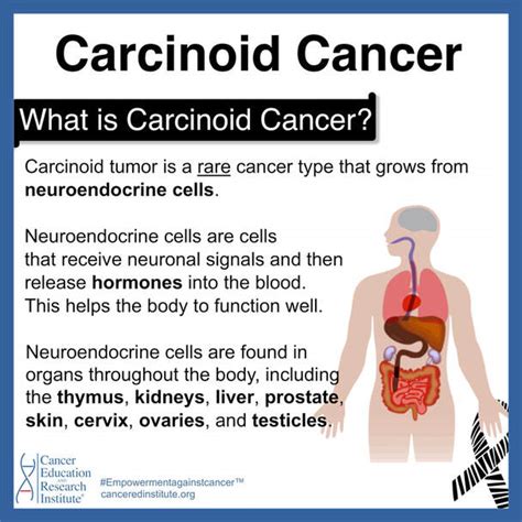 Carcinoid Cancer - Cancer Education and Research Institute