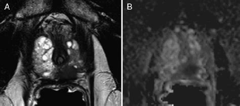 Restricted diffusion within a prostate cancer. T2-weighted scan ...