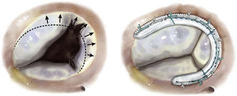 Rationale and initial experience with the Tri-Ad Adams tricuspid ...