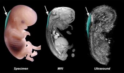 Apa itu NT Scan atau Nuchal Translucency Scan? - Ultrasound Scan ...