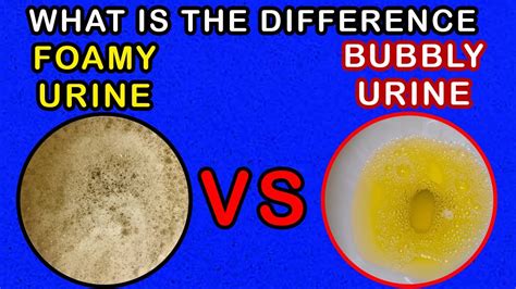 Differences between Foamy Urine Vs Bubbly Urine - YouTube