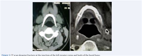 [PDF] Unidentified Hyoid Bone Fracture and its Possible Impact on the ...