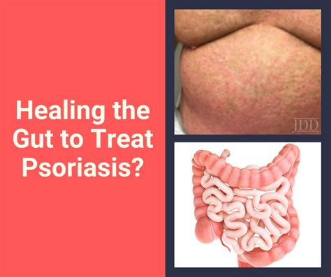 Healing the Gut to Treat Psoriasis? - Next Steps in Dermatology