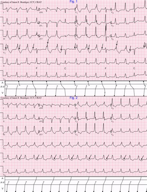 Accelerated idioventricular rhythm | ECG Guru - Instructor Resources