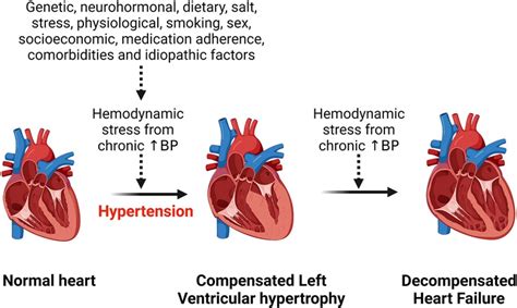 Frontiers | Hypertensive heart disease: risk factors, complications and ...