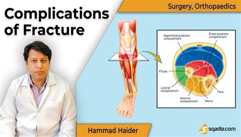 Complications of Fracture - Introduction