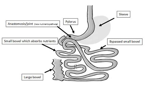 Loop-Duodenal Switch (SADI-S / SIPS) - General Surgeon Gold Coast ...