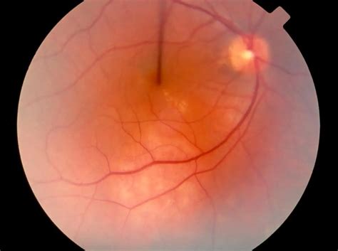 Choroidal hemangioma - American Academy of Ophthalmology