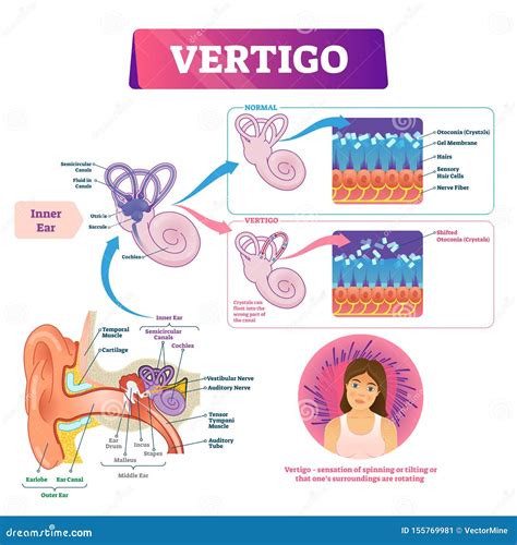 Vertigo Vector Illustration. Labeled Medical Vestibular Ear Problem ...