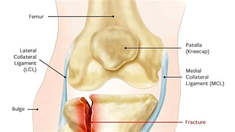 Proximal Tibia/Fibula Fracture - Carolina Regional Orthopedics