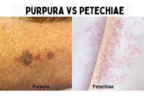 Ecchymosis Vs Petechiae