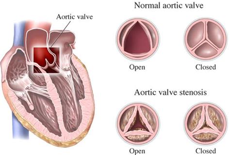 Heart valve disease treatment in New Jersey