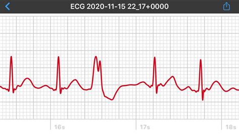 What is this?? I had a rapid a-fib episode in January, have always had ...