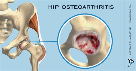 What underlying diseases cause hip pain? - Health Blog