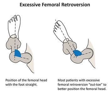 Excessive Femoral Retroversion | Physical therapy, Yoga anatomy, Sports ...