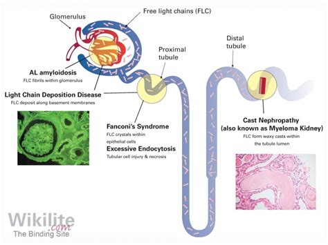 Kappa Free Light Chain Disease | Shelly Lighting