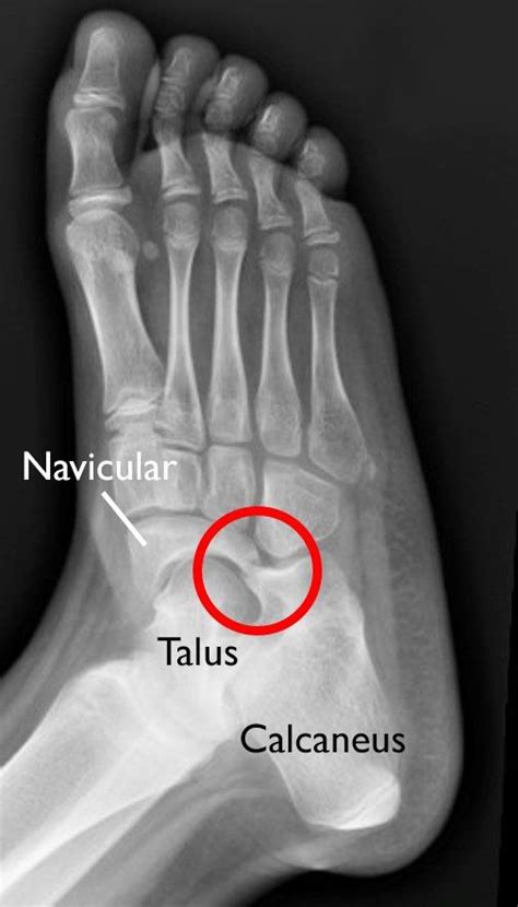 Tarsal Coalition - OrthoInfo - AAOS