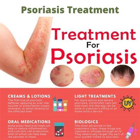 Psoriasis Treatment