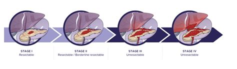 Stages Of Pancreatic Cancer