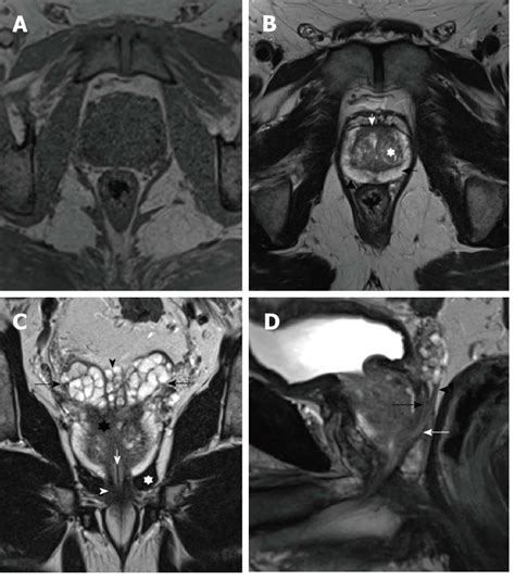 Prostate Axial Mri Anatomy